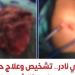 إنجاز
      طبي
      نادر،
      معهد
      القلب
      ينجح
      في
      تشخيص
      وعلاج
      أول
      حالة
      موثقة
      عالميًا
      لبطانة
      الرحم
      داخل
      الرئة