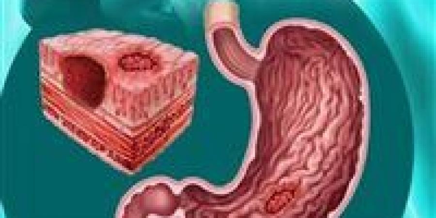 "وجع صامت يبدأ بحرقة خفيفة " قرحة المعدة وخطورتها وكيف يتم التعامل معها؟