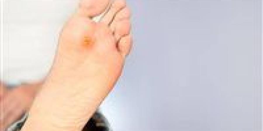 مسامير
      القدم
      العظمية..
      أسبابها
      وطرق
      الوقاية
      كما
      يوضح
      الأطباء