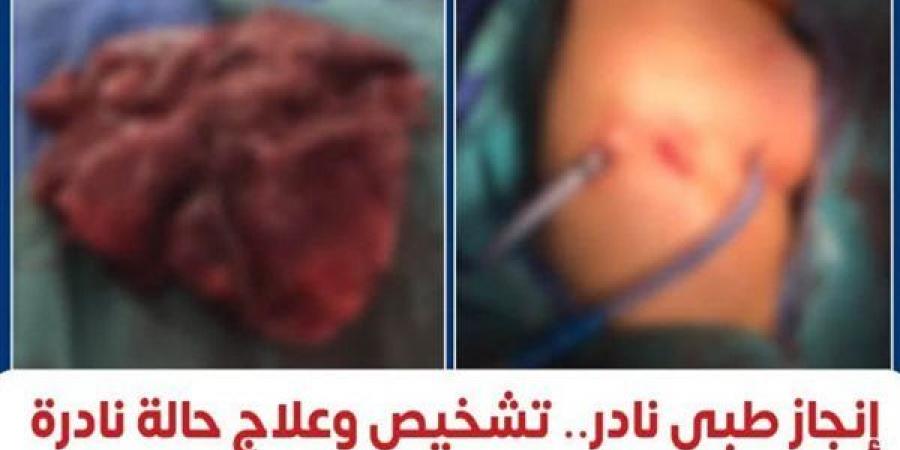 إنجاز
      طبي
      نادر،
      معهد
      القلب
      ينجح
      في
      تشخيص
      وعلاج
      أول
      حالة
      موثقة
      عالميًا
      لبطانة
      الرحم
      داخل
      الرئة